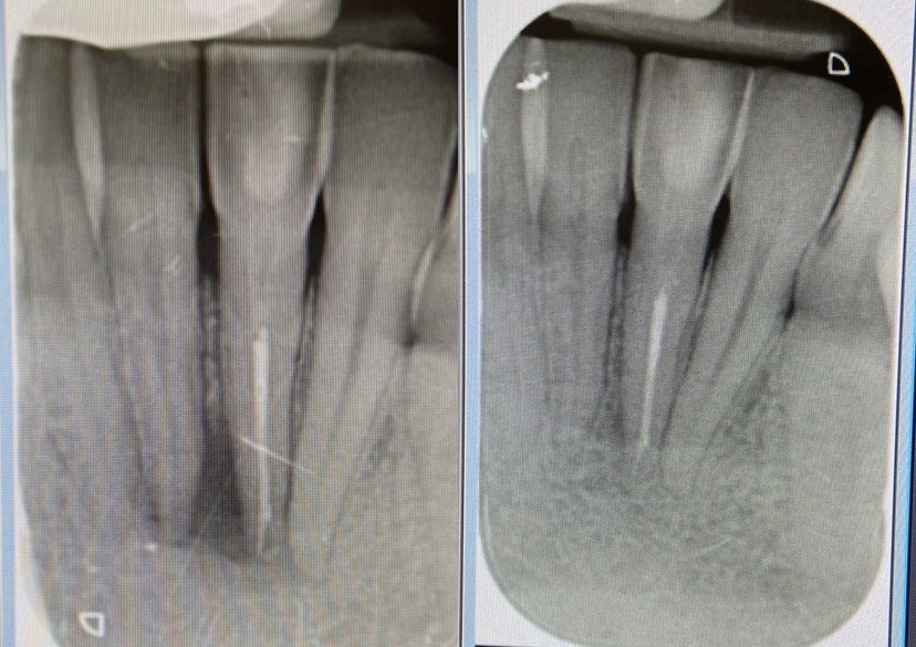 Radiografia a fine endodonzia dove si nota il corretto sigillo e radiografia di controllo dove si evince la completa guarigione del granuloma