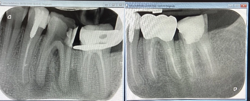 Prima e dopo Prima lesione con granuloma evidente. Dopo completa guarigione e corona in ceramica